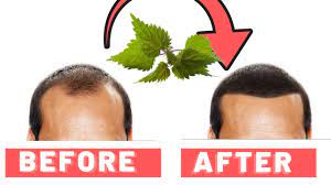 Sting nettle powder for Hair loss Sting-nettle-powder-for-Hair-loss