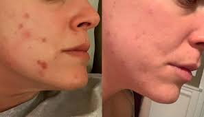 skin changes after clandula